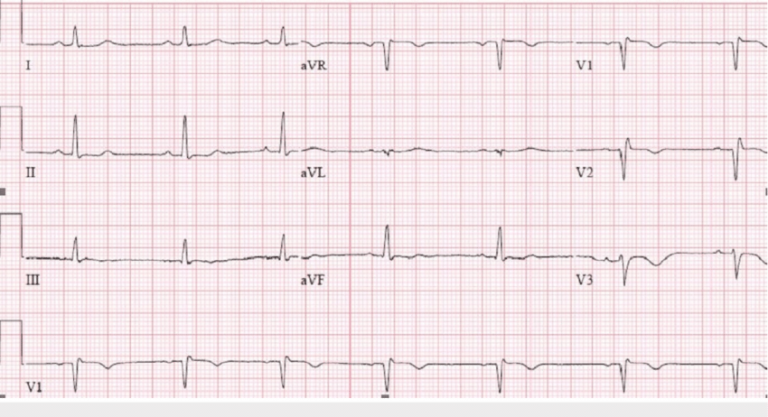 ECG for heart disease