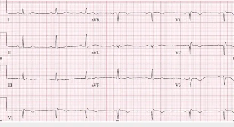 ECG for heart disease