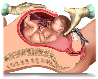 Cesarean Section in high risk pregnancies